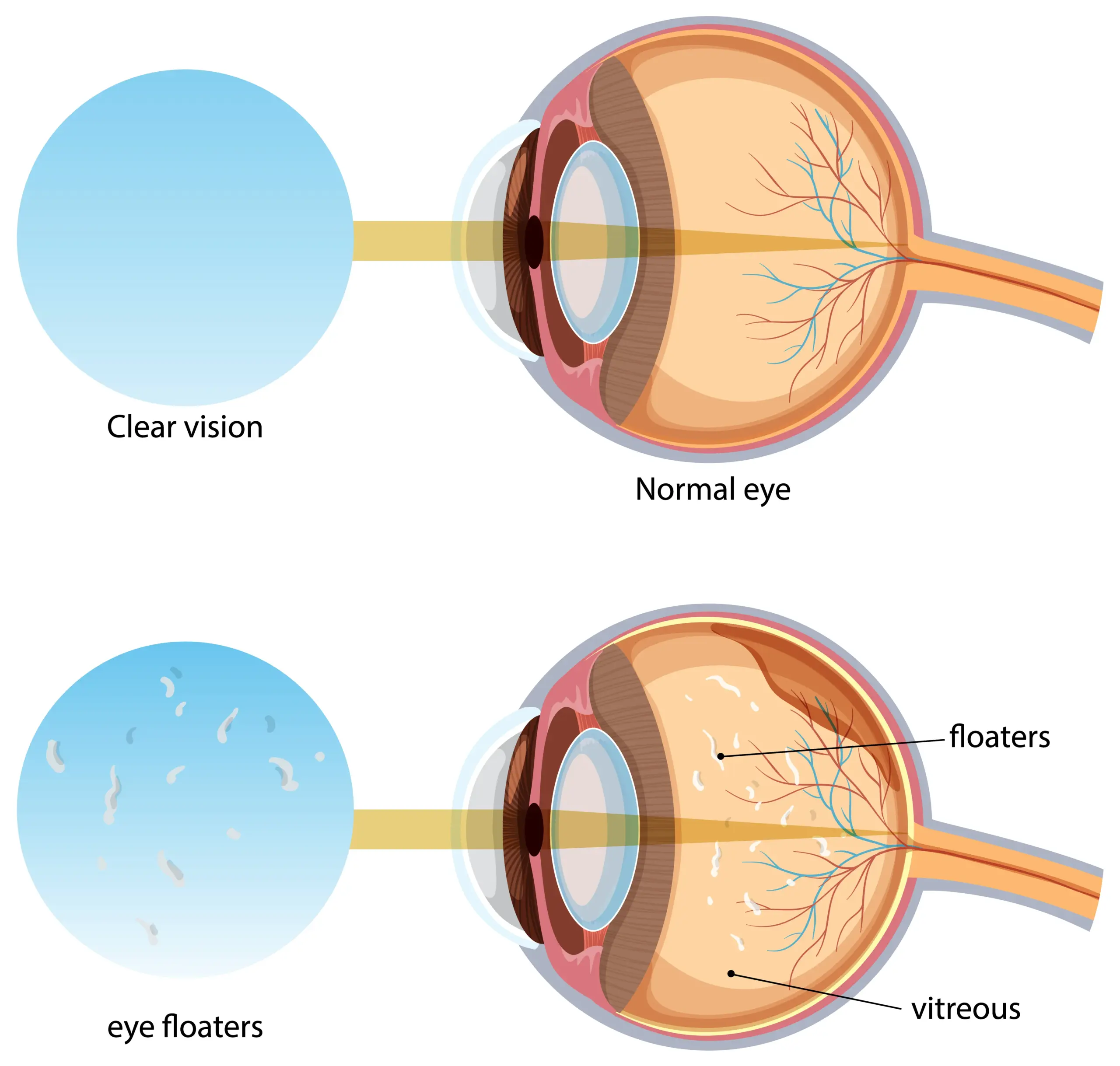 Diagram comparing a normal eye with clear vision to an eye experiencing vitreous floaters, showing light path distortion caused by debris.