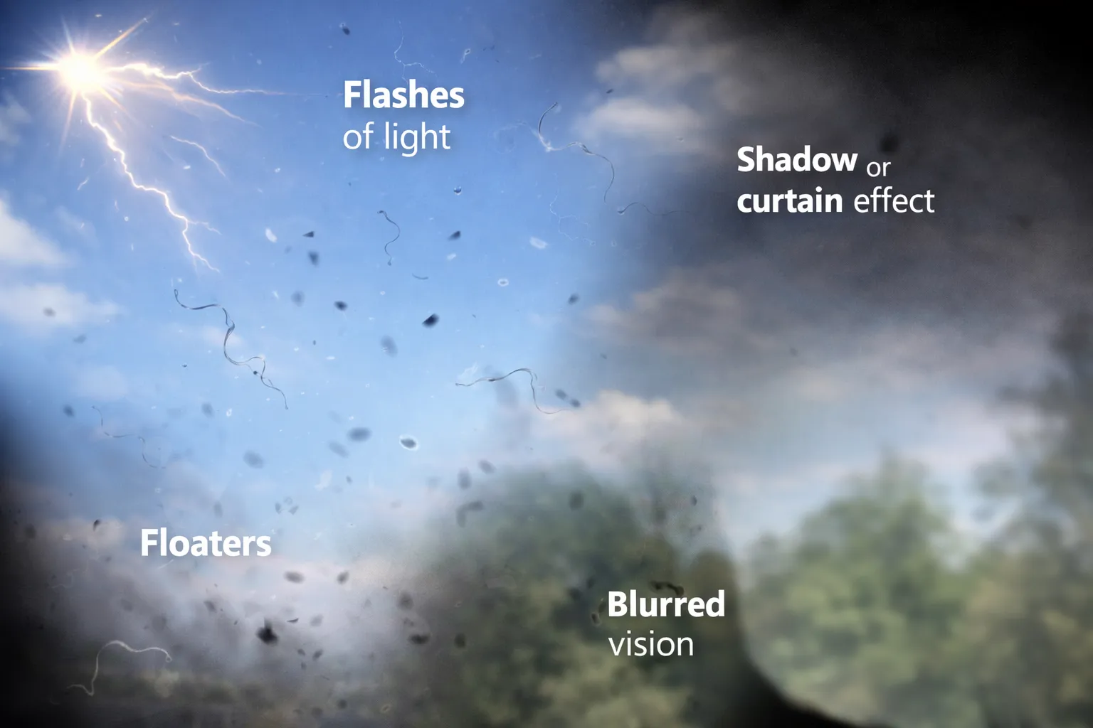 Visualizing retinal symptoms: floaters, lightning flashes of light, blurring, and a dark shadow or curtain effect blocking the field of vision.
