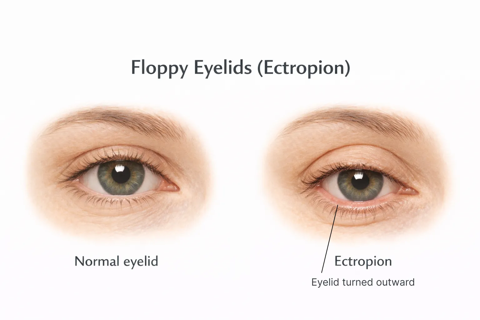 Medical comparison of two eyes: one with a normal eyelid and one showing Ectropion, where the lower lid sags outward.