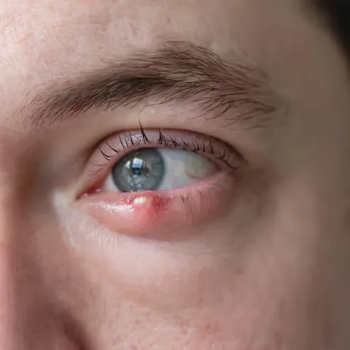 Eye stye close-up