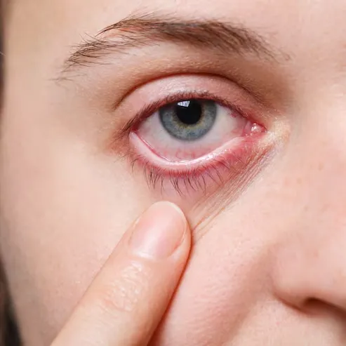 Red, irritated eye close-up