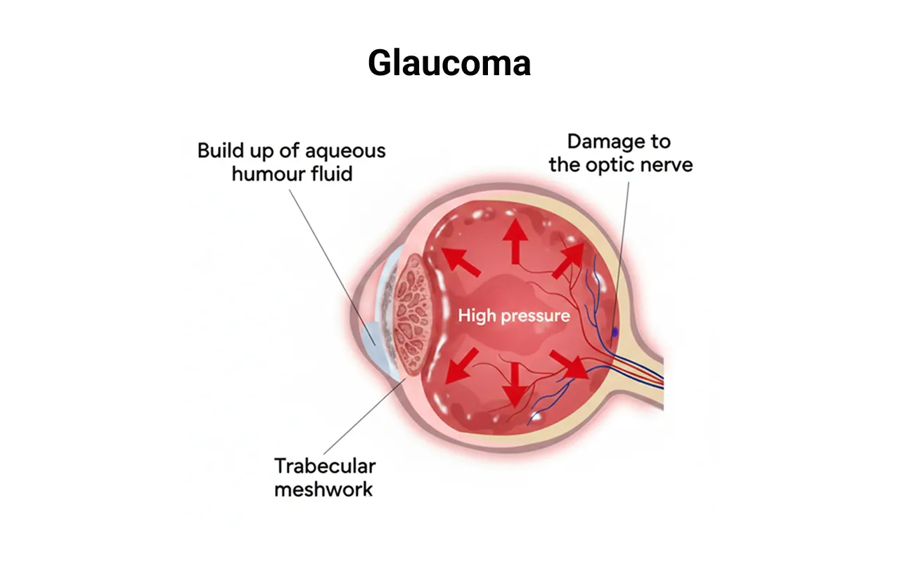 eye with glaucoma disease medical infographic