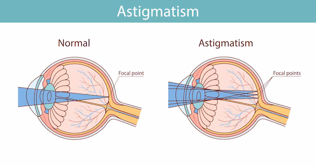 Diagram illustrating astigmatism, comparing a "Normal" eye, where light converges to a single focal point on the retina, with an "Astigmatism" eye, where light scatters into multiple focal points.