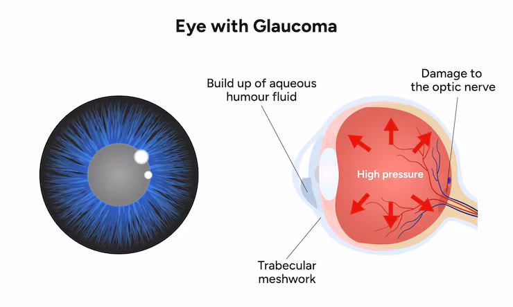 eye with glaucoma disease medical infographic with human eye optic anatomy