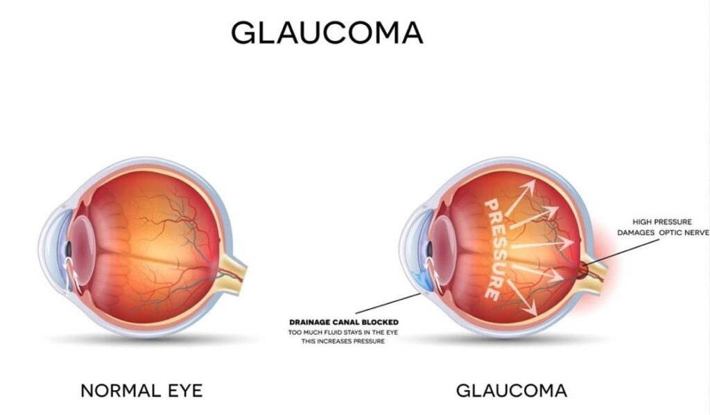 Normal vs glaucoma eye pressure