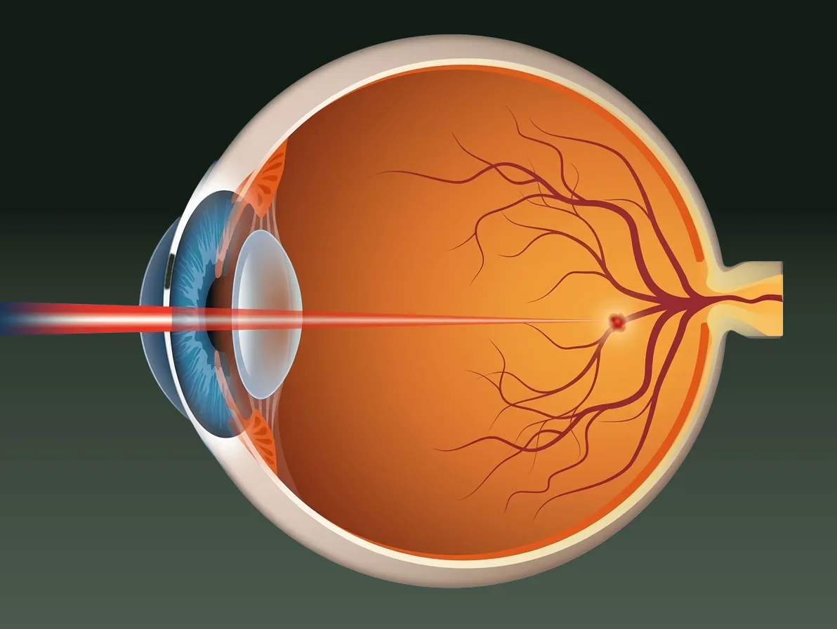 Diagram showing a laser targeting a retinal tear, with stages of photocoagulation treatment.