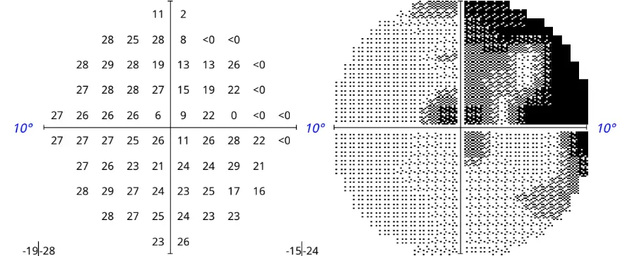Humphrey Visual Field test, left eye, July 2026