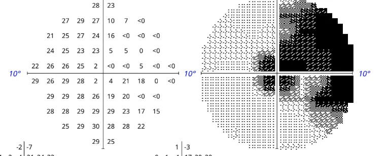 Humphrey Visual Field test, right eye, July 2026