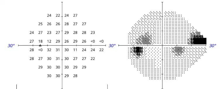 Humphrey Visual Field test charts, patient's son, left eye