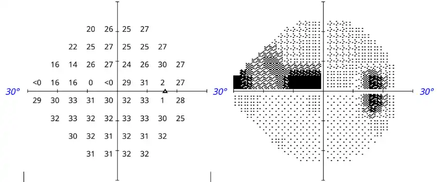Humphrey Visual Field test charts, patient's son, right eye